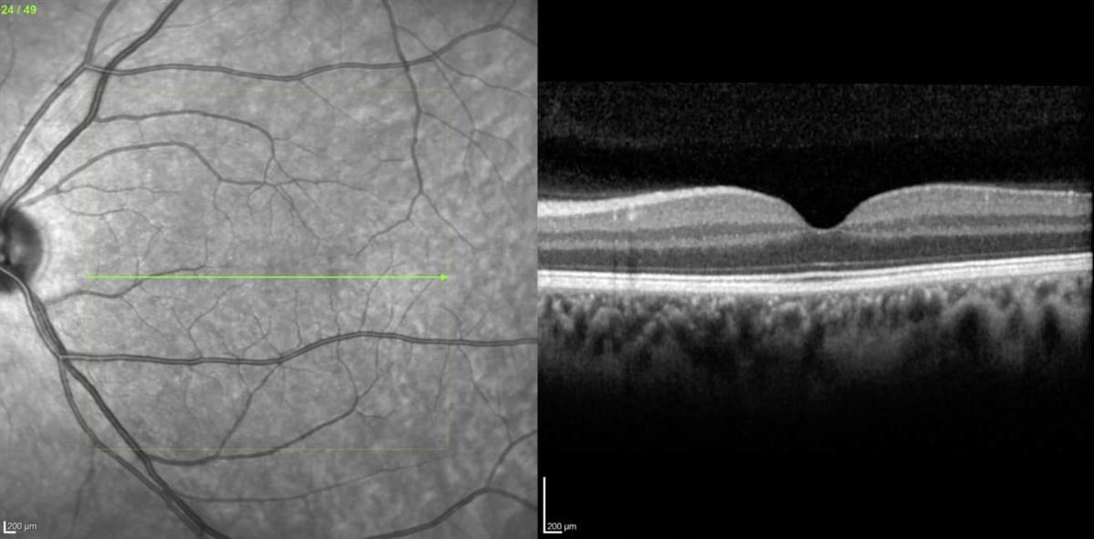 Makuladegeneration (AMD) in Ludwigshafen: Symptome und Früherkennung