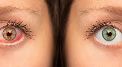 Trockene Augen – Vergleich gesundes und trockenes Auge, Meibomdrüsendysfunktion