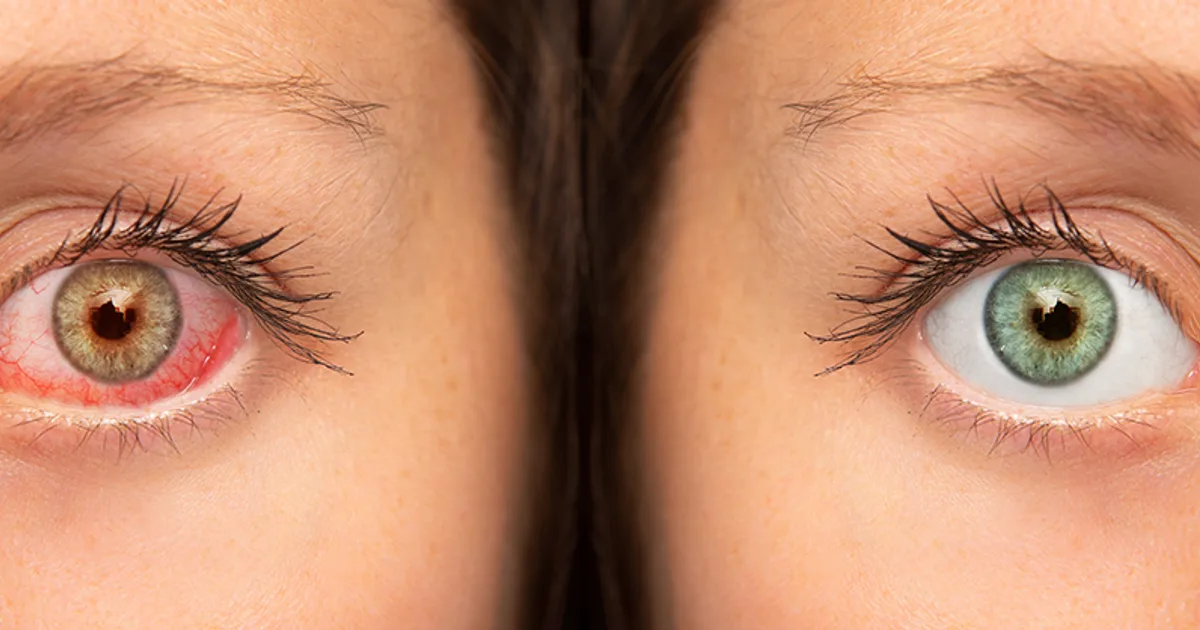 Vergleich gesundes Auge und trockenes Auge – Rötung, Fremdkörpergefühl und Tränenfilmstörung in Ludwigshafen behandeln